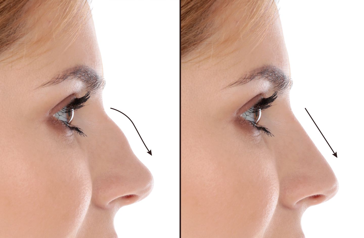 before and after rhinoplasty profile view showing refined nose shape