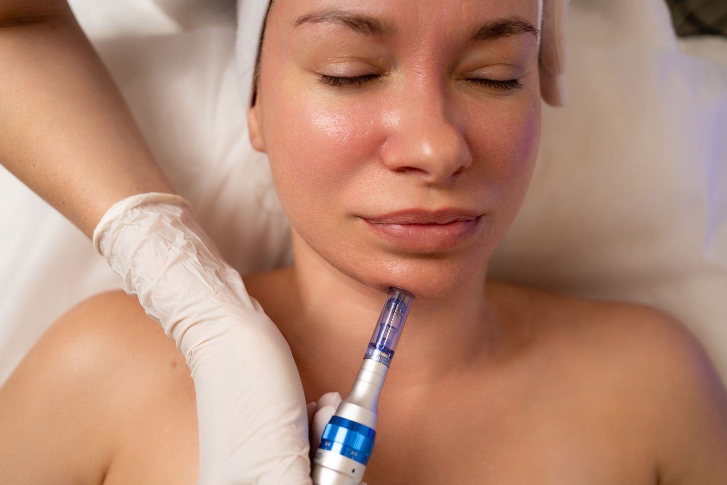 Woman receiving a microneedling procedure to treat facial acne scarring